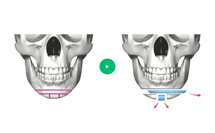 Dagu Panjang T-Osteotomy