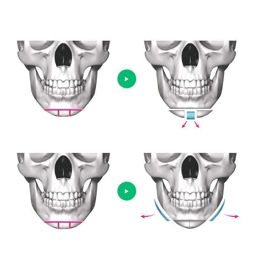 T-Osteotomy