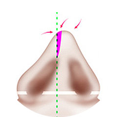 Metode Potong Tulang Hidung