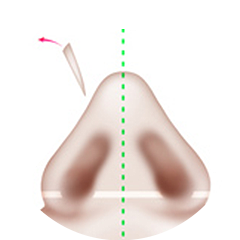 鼻骨切骨法