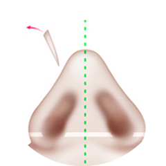 Nasal bone fracture Method