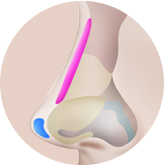 Nasal bridge augmentation after hump removal