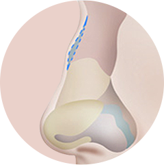 Nasal bridge augmentation after hump removal