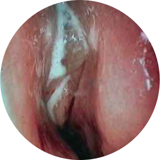 Severely inflamed paranasal cavity Case01