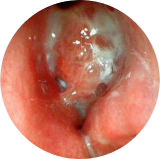 Perawatan untuk Sinusitis Kronis Kasus02