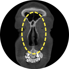 Straightened septal cartilage after the surgery