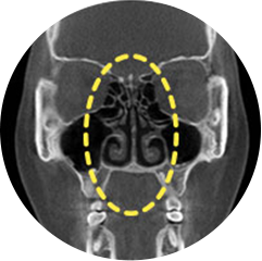 Straightened septal cartilage after the surgery