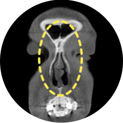 Deviated septal cartilage