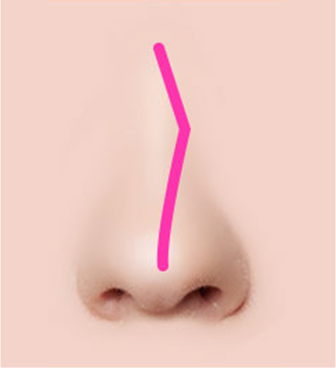 Various cases of deviated nasal septum