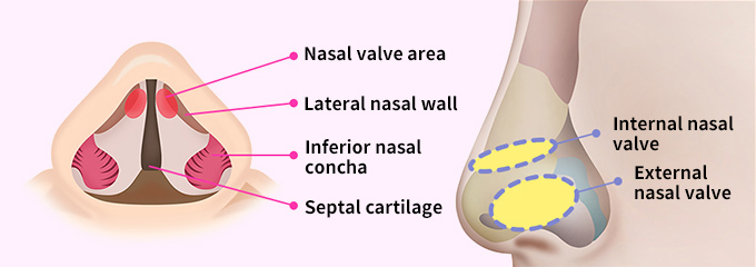 Valve Reconstruction Surgical Points Step 02