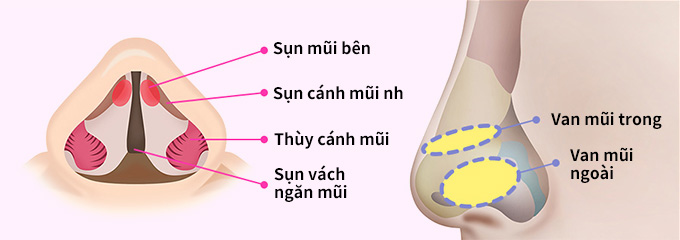 Đặc điểm phẫu thuật hẹp van mũi Bước 02