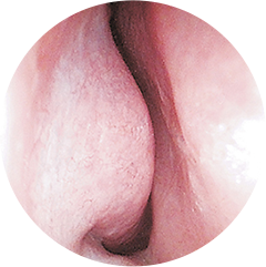 炎症除去でスッキリ！確保された鼻の内部空間