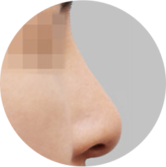 プロテーゼによる鼻先の変形