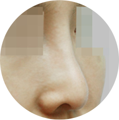 Under-projected nasal tip