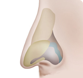 鼻柱整形の手術方法01