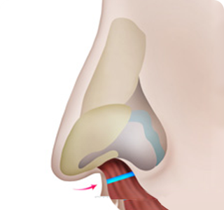 鼻柱整形の手術方法03