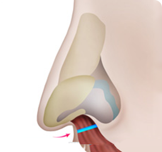 Arrowed Nasal Tip Step 03