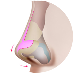 Cartilage Repositioning Method