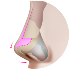 鼻翼軟骨の再配置