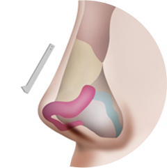 Cartilage Transplant Method