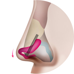Cartilage Transplant Method