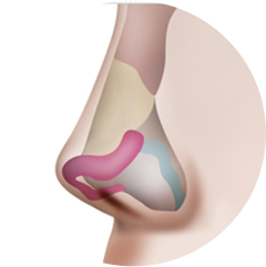 Cartilage Repositioning + Cartilage Transplant + Augmentation Rhinoplasty
