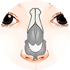 Wide nasal cartilage