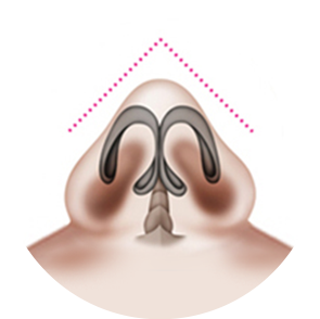 Types of Blunt Nose