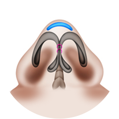 Nasal tip that requires augmentation