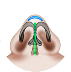 Nasal Tip That Requires Augmentation And Strong Support