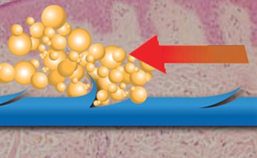 Regular Cutting barb  (Skin fixation)