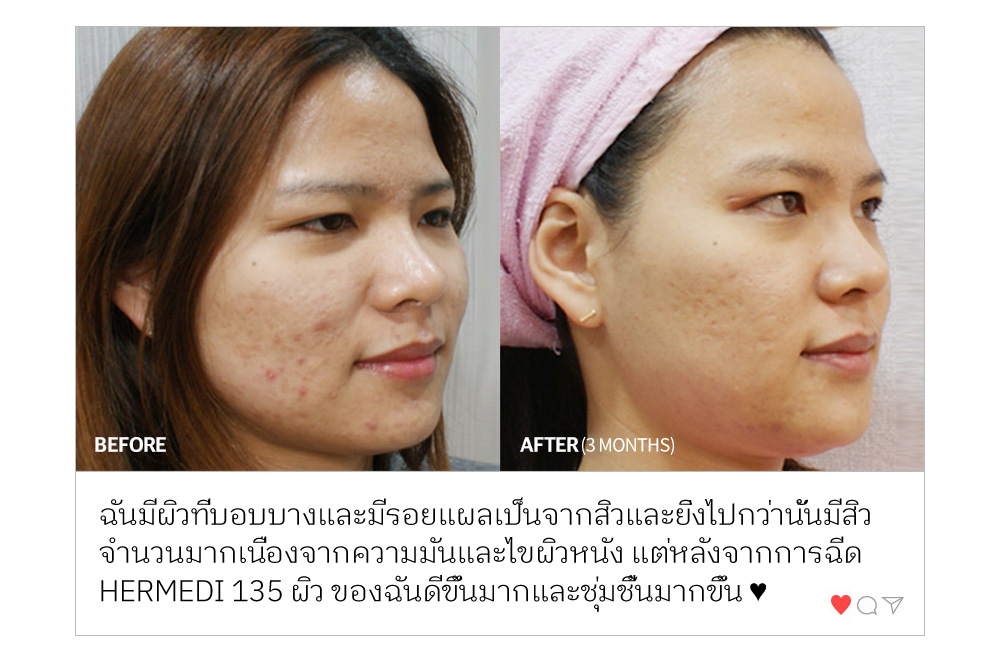 BEFORE % AFTER (3 MONTHS) ฉันมีผิวที่บอบบางและมีรอยแผลเป็นจากสิวและยิ่งไปกว่านั้นมีสิว จำนวนมากเนื่องจากความมันและไขผิวหนัง แต่หลังจากการฉีด HERMEDI 135 ผิว ของฉันดีขึ้นมากและชุ่มชื้นมากขึ้น ♥