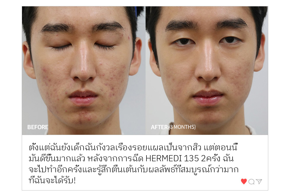 BEFORE % AFTER (3 MONTHS) ตั้งแต่ฉันยังเด็กฉันกังวลเรื่องรอยแผลเป็นจากสิว แต่ตอนนี้ มันดีขึ้นมากแล้ว หลังจากการฉีด HERMEDI 135 2ครั้ง ฉัน จะไปทำอีกครั้งและรู้สึกตื่นเต้นกับผลลัพธ์ที่สมบูรณ์กว่ามาก ที่ฉันจะได้รับ!