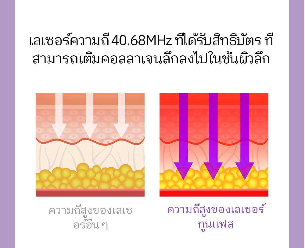 เลเซอร์ความถี่ 40.68MHz ที่ได้รับสิทธิบัตร ที่ สามารถเติมคอลลาเจนลึกลงไปในชั้นผิวลึก / ความถี่สูงของเลเซอร์อื่น ๆ / ความถี่สูงของเลเซอร์ทูนเเฟส