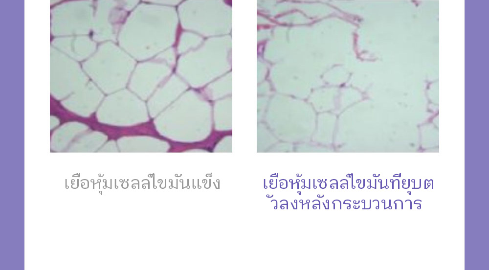  เยื่อหุ้มเซลล์ไขมันแข็ง เยื่อหุ้มเซลล์ไขมันที่ยุบต วลงหลังกระบวนการ