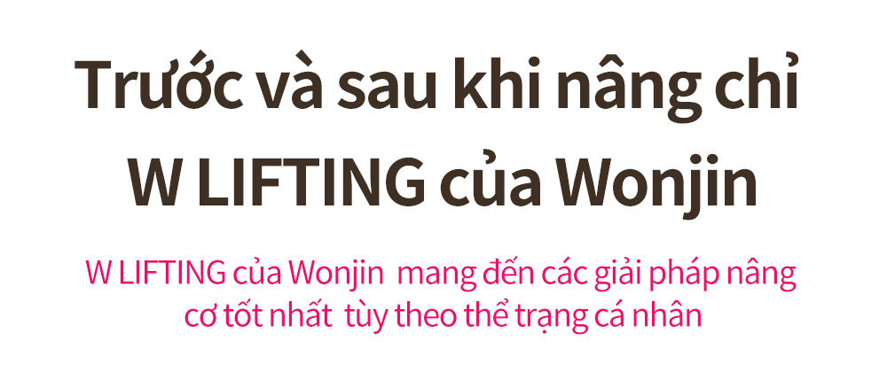 Trước và sau khi nâng chỉ W LIFTING của Wonjin W LIFTING của Wonjin  mang đến các giải pháp nâng cơ tốt nhất  tùy theo thể trạng cá nhân