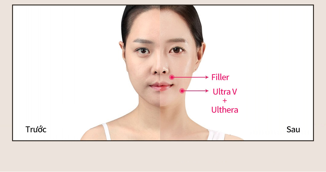 Trước Sau -Filler -Ultra V+Ulthera