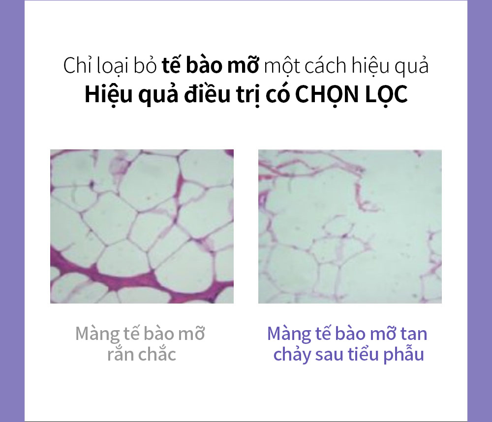 Chỉ loại bỏ tế bào mỡ một cách hiệu quảHiệu quả điều trị có CHỌN LỌC , Màng tế bào mỡ rắn chắc / Màng tế bào mỡ tan chảy sau tiểu phẫu